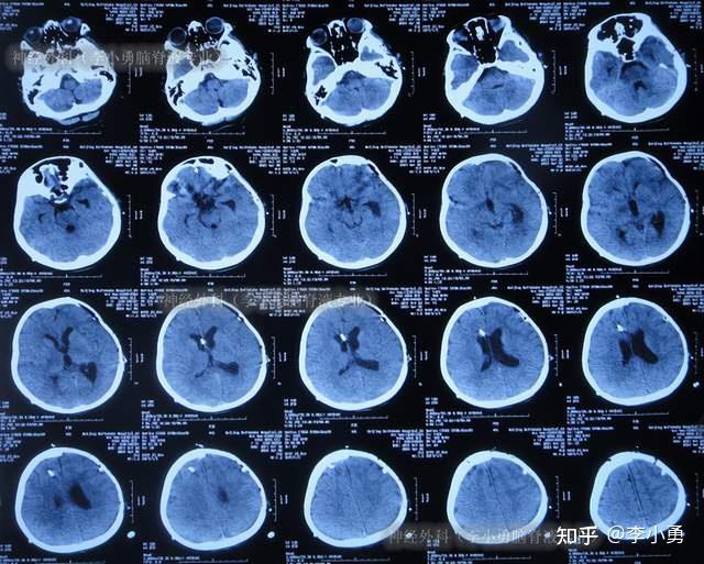 脑膜炎性颅内积脓,去骨瓣开颅术后刀口仍流脓,意识障碍,不能走路,转至