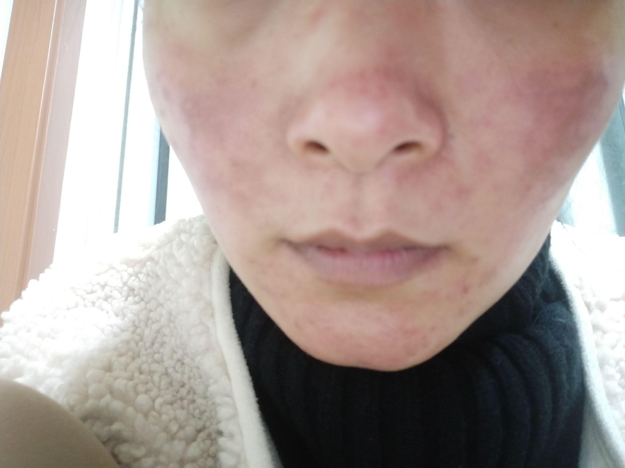 果酸换肤后脸能有多吓人