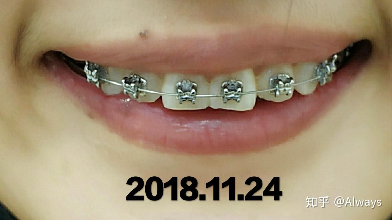 正畸矫正22岁带自锁牙套的全过程