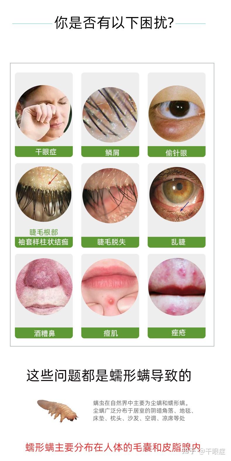 麦粒肿怎么办？ - 知乎