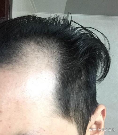 男性m型脱发的两种原因以及治疗方法 