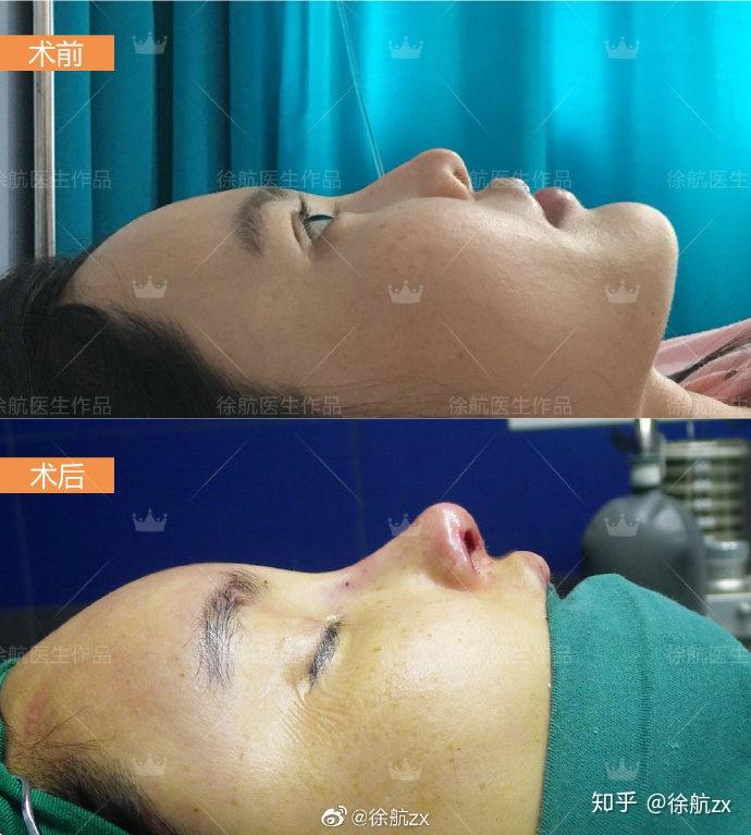 第三次整形后的效果