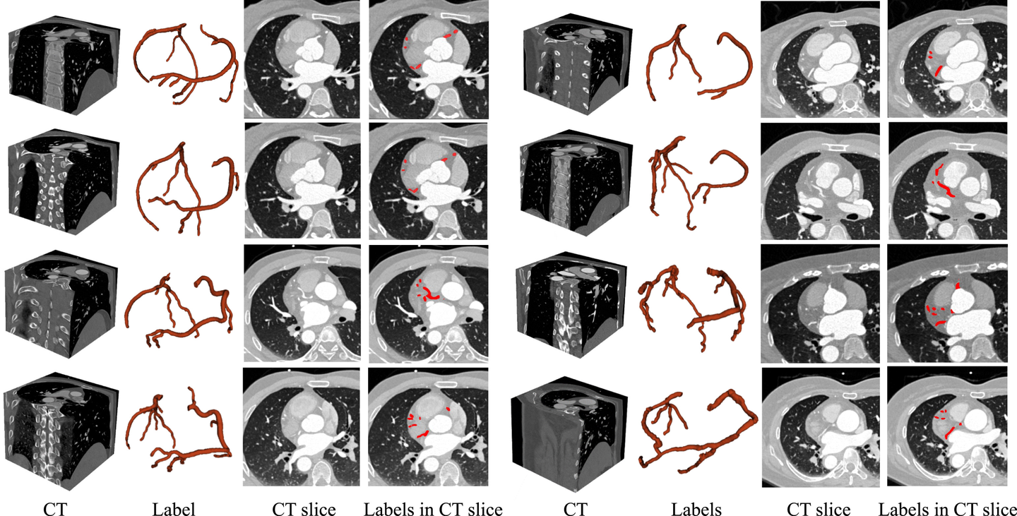 ImageCAS 大规模 CT 血管造影图像冠状动脉分割数据集介绍 - 知乎