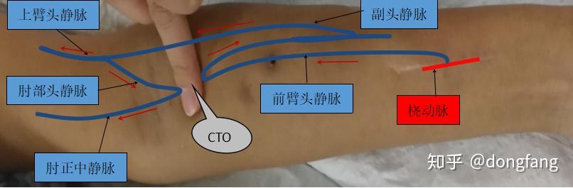 Dsa超声联合下动静脉内瘘cto锐性开通术 知乎 0211