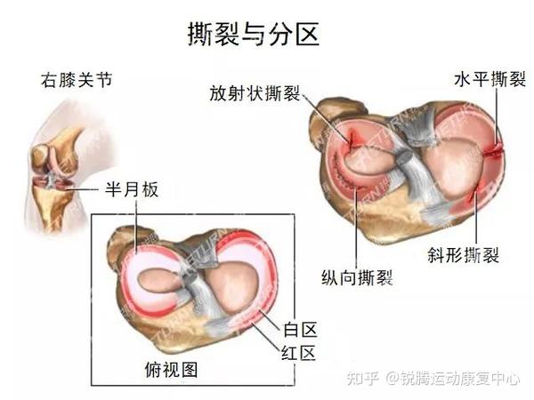半月板损伤 我该拿什么拯救你 知乎