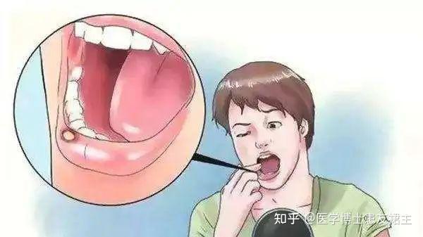 舌癌的早期症状及预防 - 知乎
