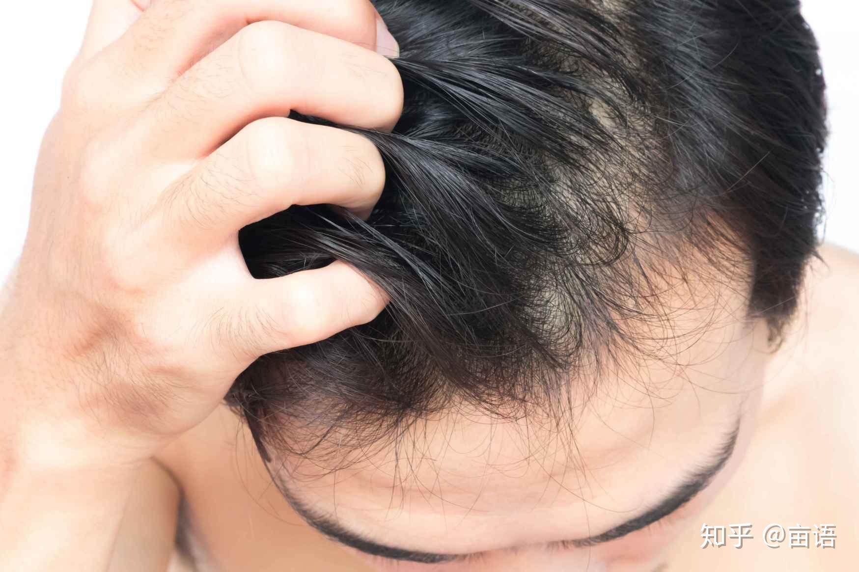 头皮总是痒痒痒,那到底是什么原因造成? - 知乎