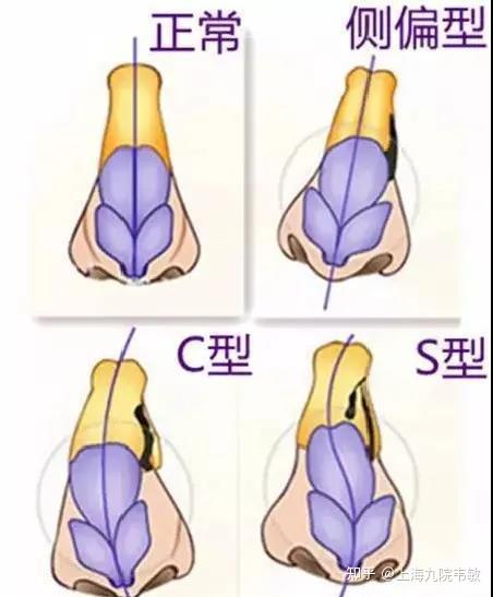 歪鼻分为骨性,软骨性及混合性3种,按形态可分"c"形,"s"形及斜形3类.