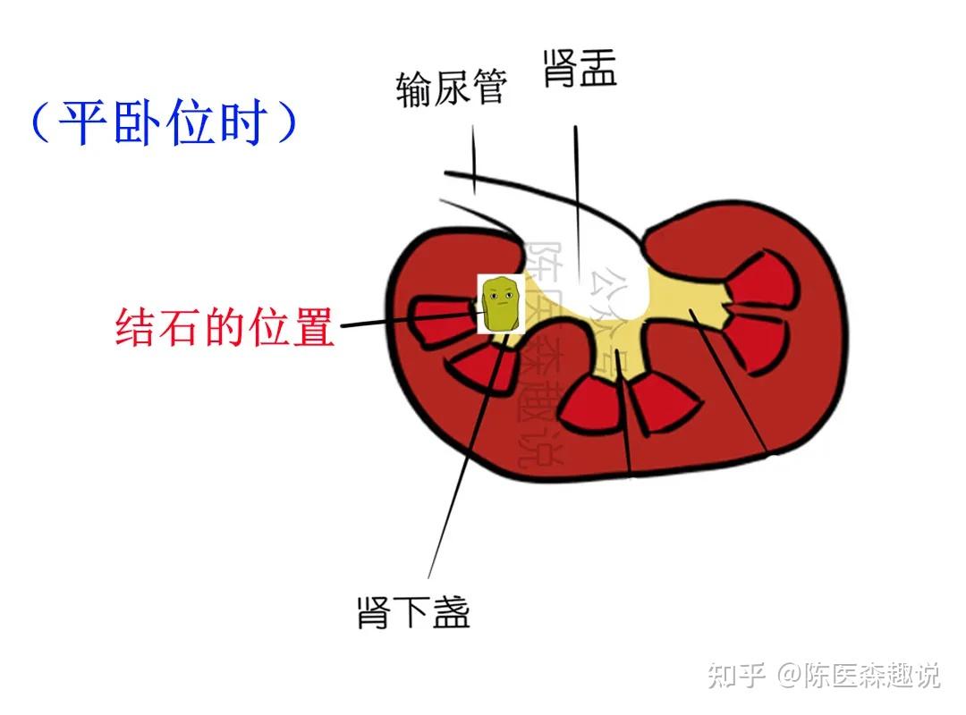 右肾铸型结石行经皮肾镜钬激光碎石术1例