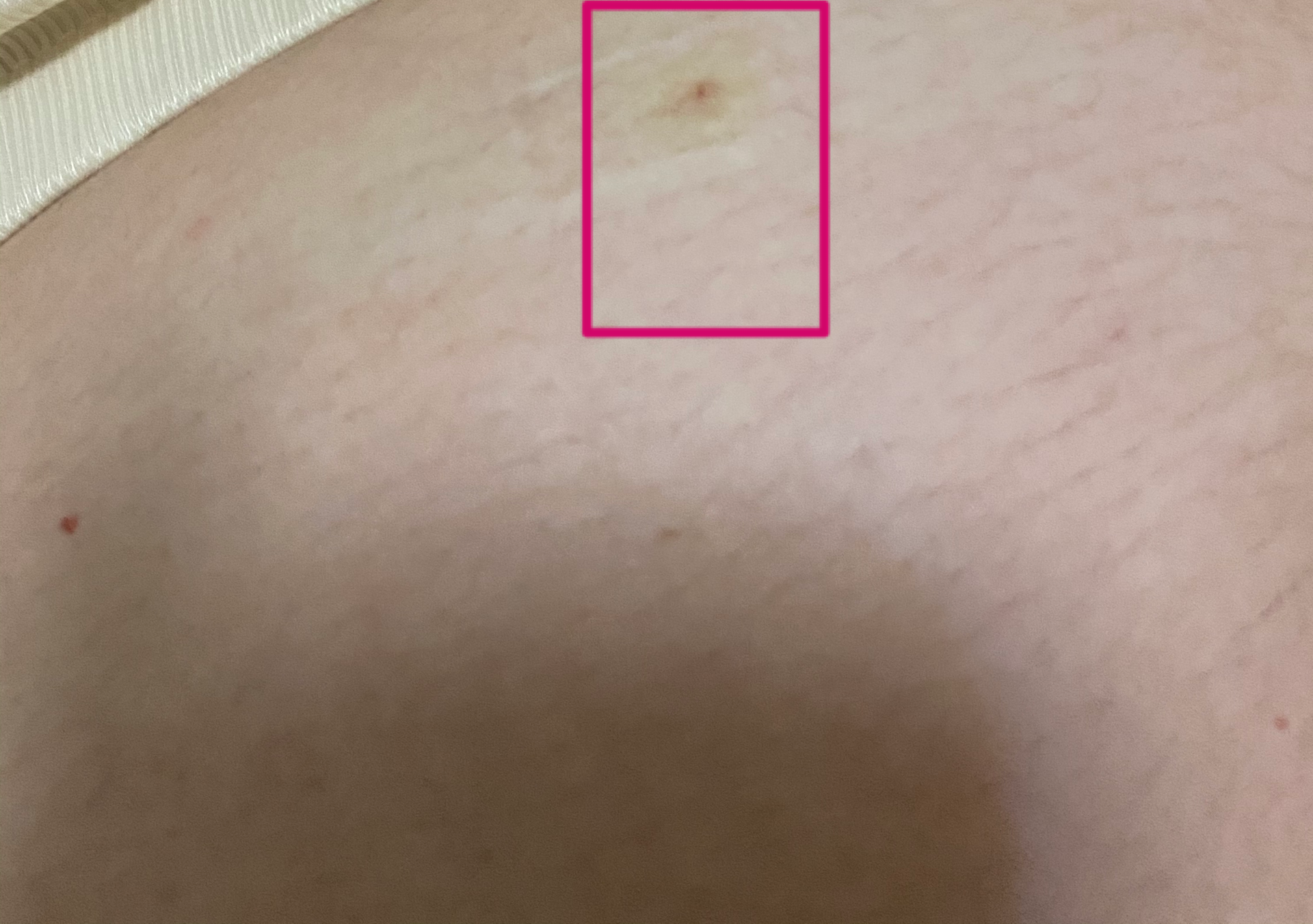 记录:羊水穿刺 - 知乎