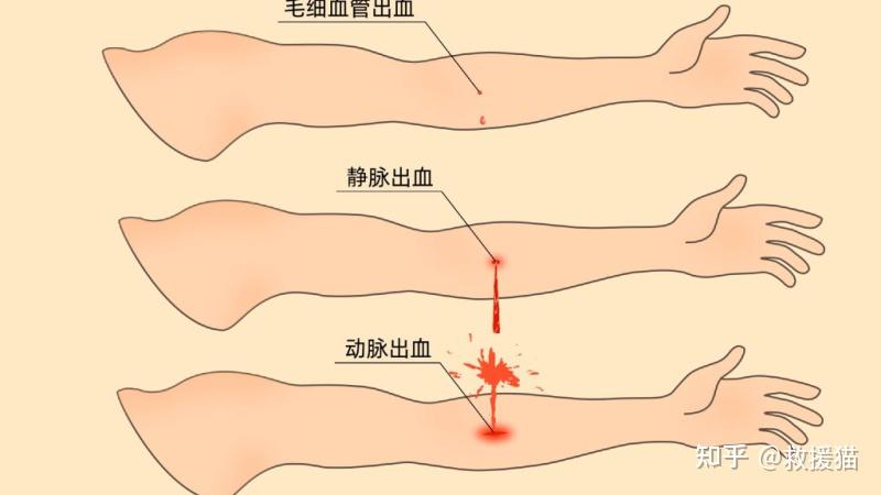 外伤出血该怎么办?正确止血是关键 - 知乎