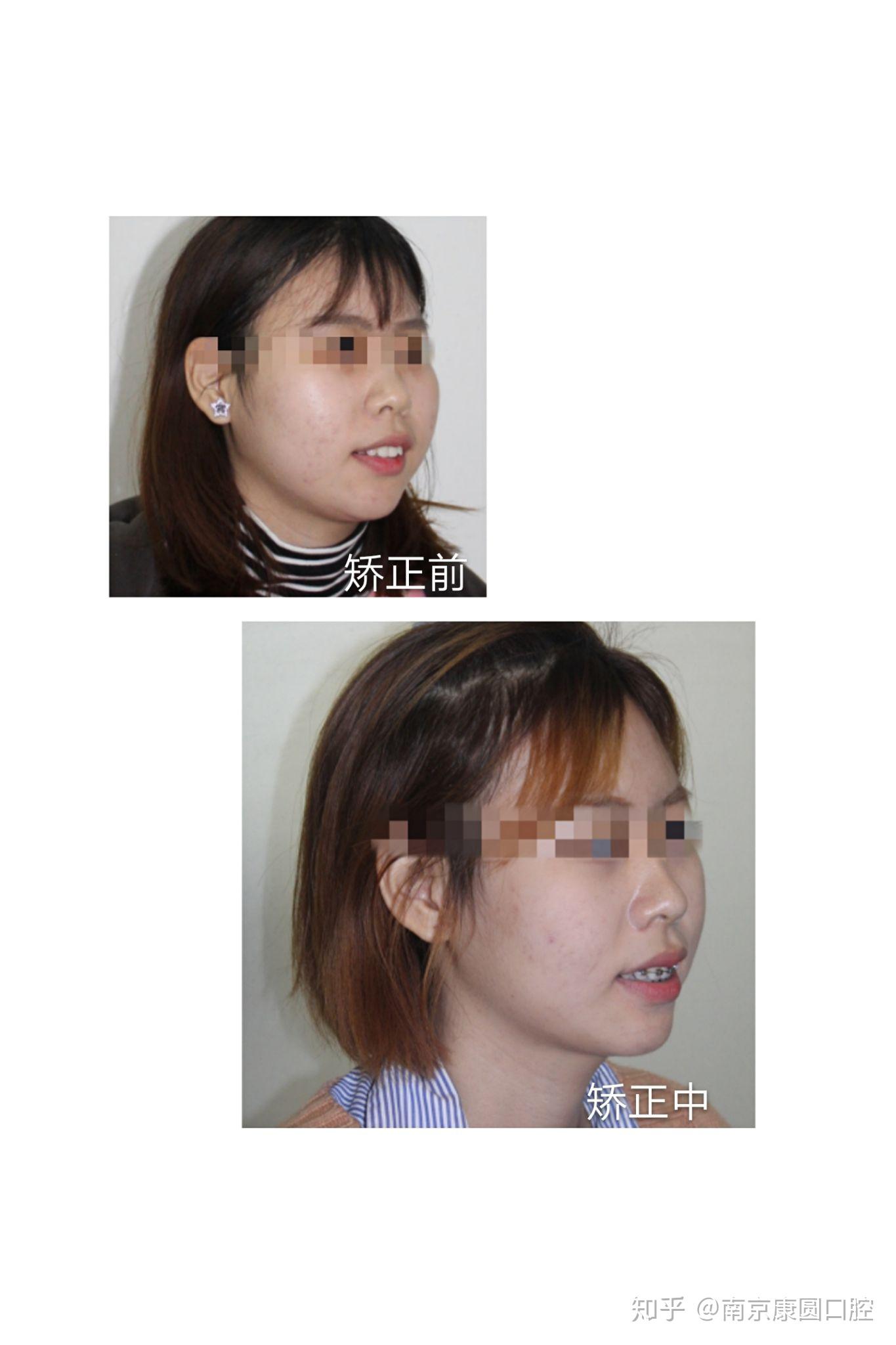 小龅牙矫正历程我变得更漂亮啦