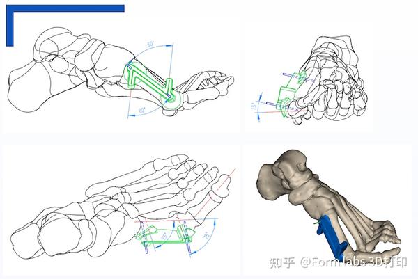 3D打印手术导板在三甲医院应用实例:高效、精确匹配不同手术类型 - 知乎