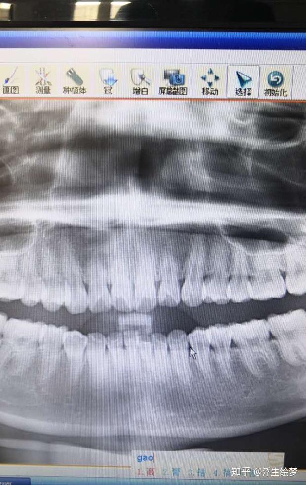 这样牙根短建议正畸吗
