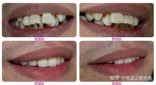 牙齿地包天的矫正方法