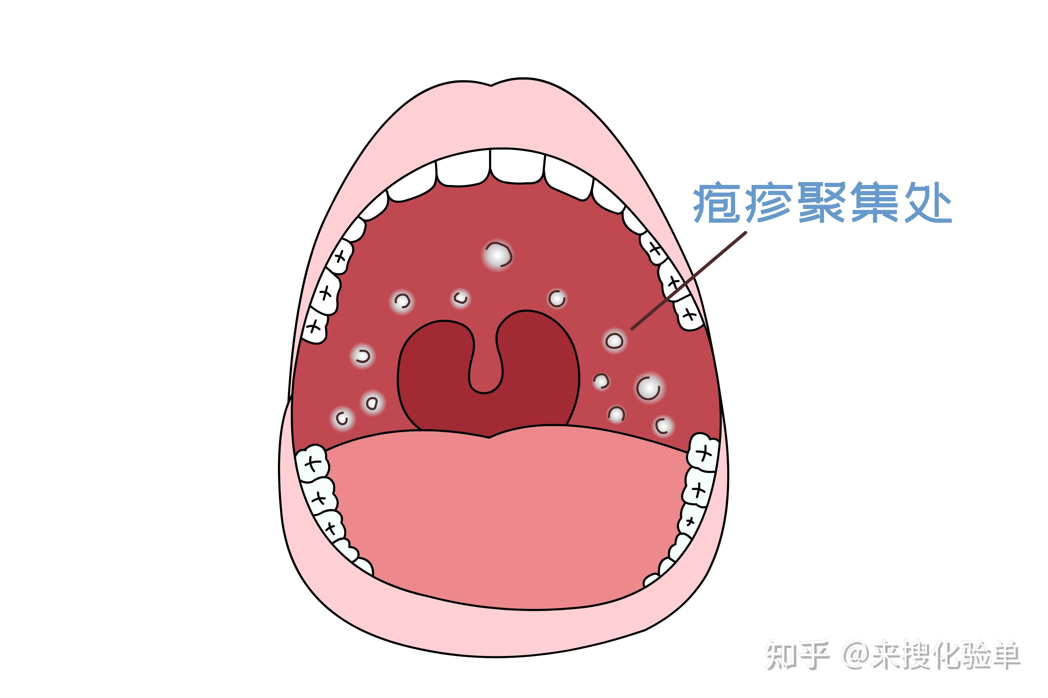 疱疹性咽颊炎的症状图片