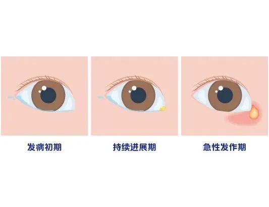 【科普】“女孩流泪8年发现泪道阻塞”冲上热搜，婴幼儿泪囊炎该如何对待？ - 知乎