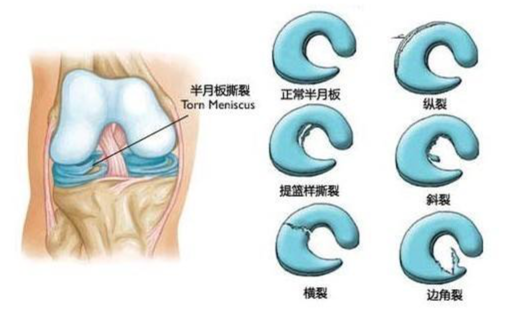 半月板损伤康复 半月板之 殇 知乎