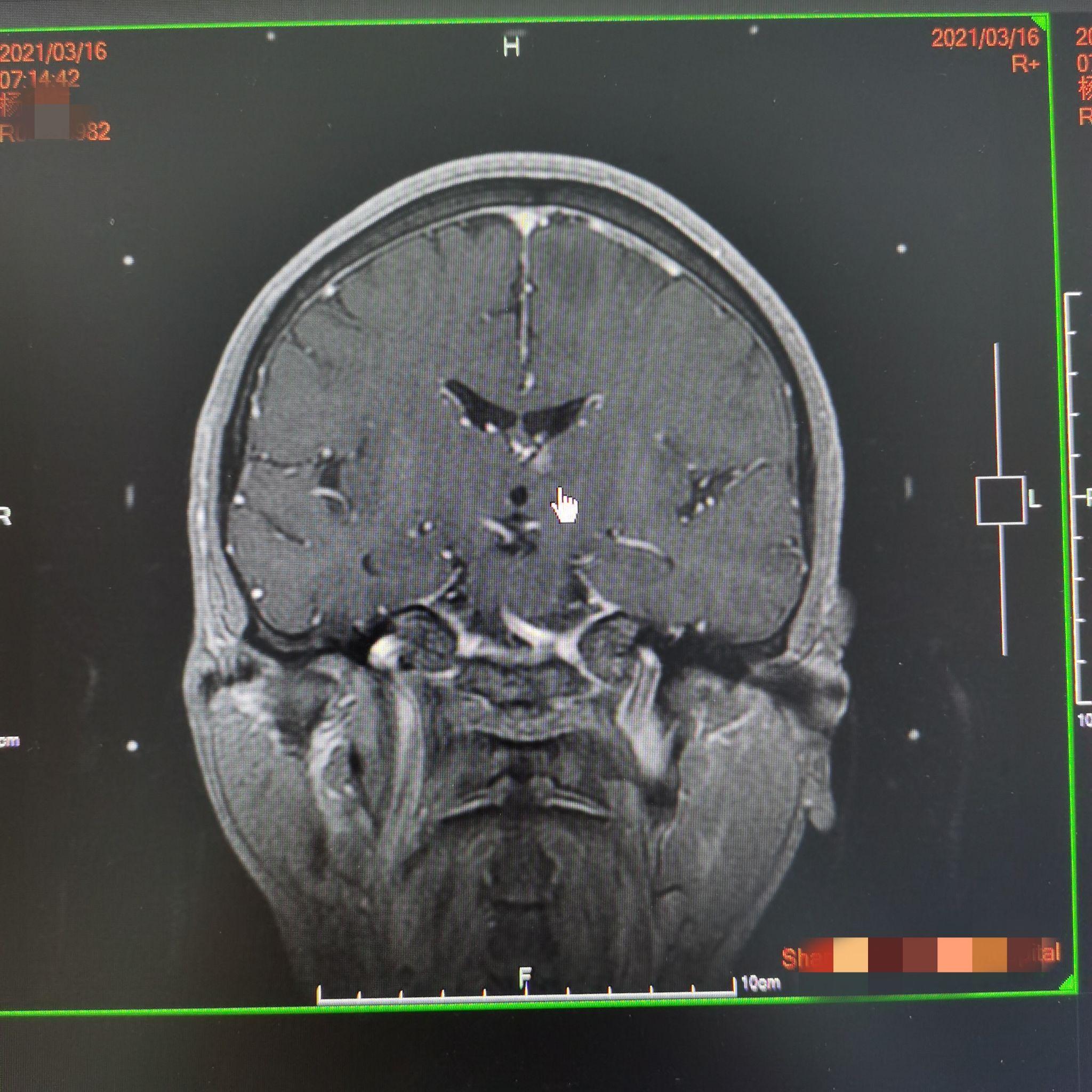 新發現之丘腦轉移灶(冠)原報告之頂葉轉移灶原報告上額葉轉移灶