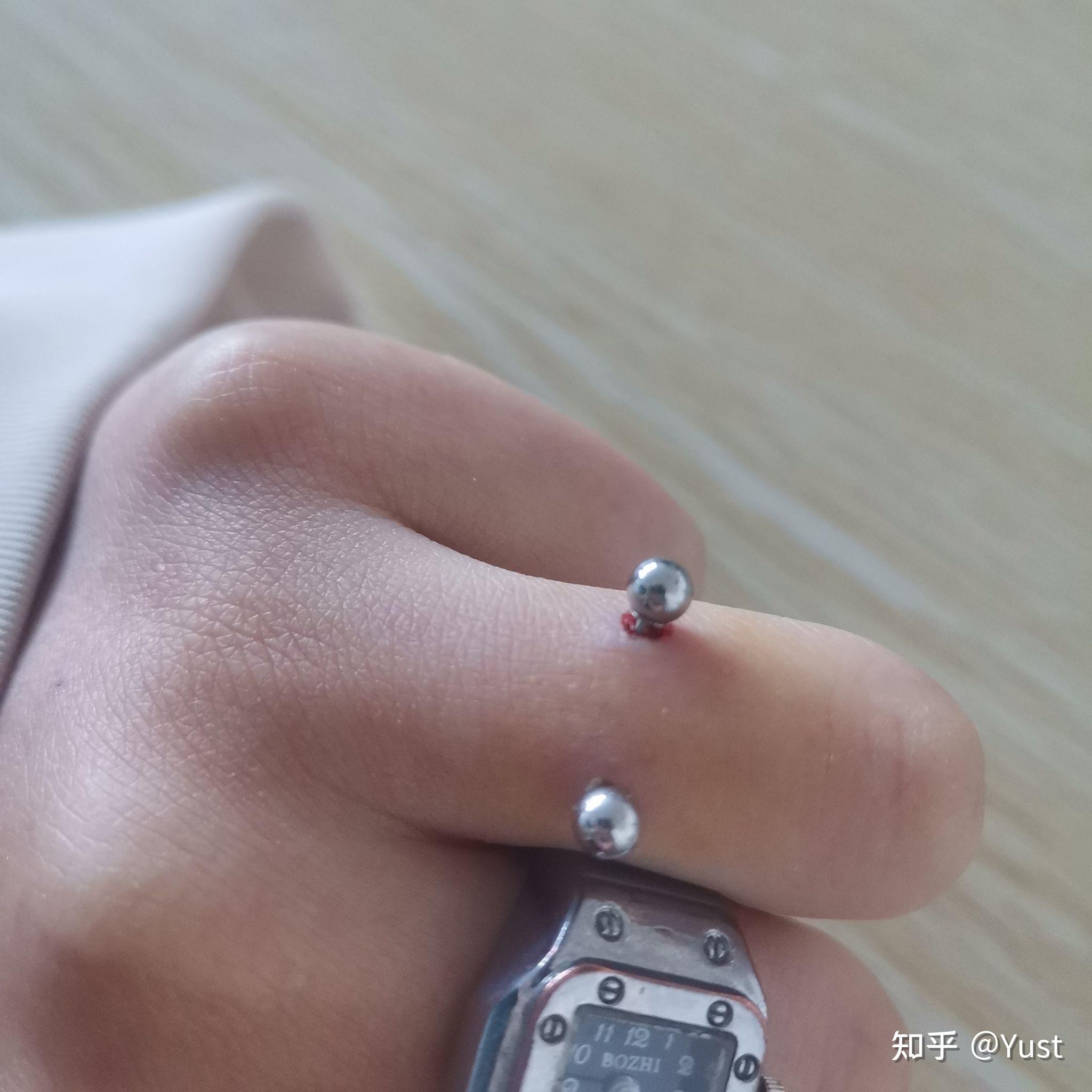 手指钉orward helix恢复记录 - 知乎