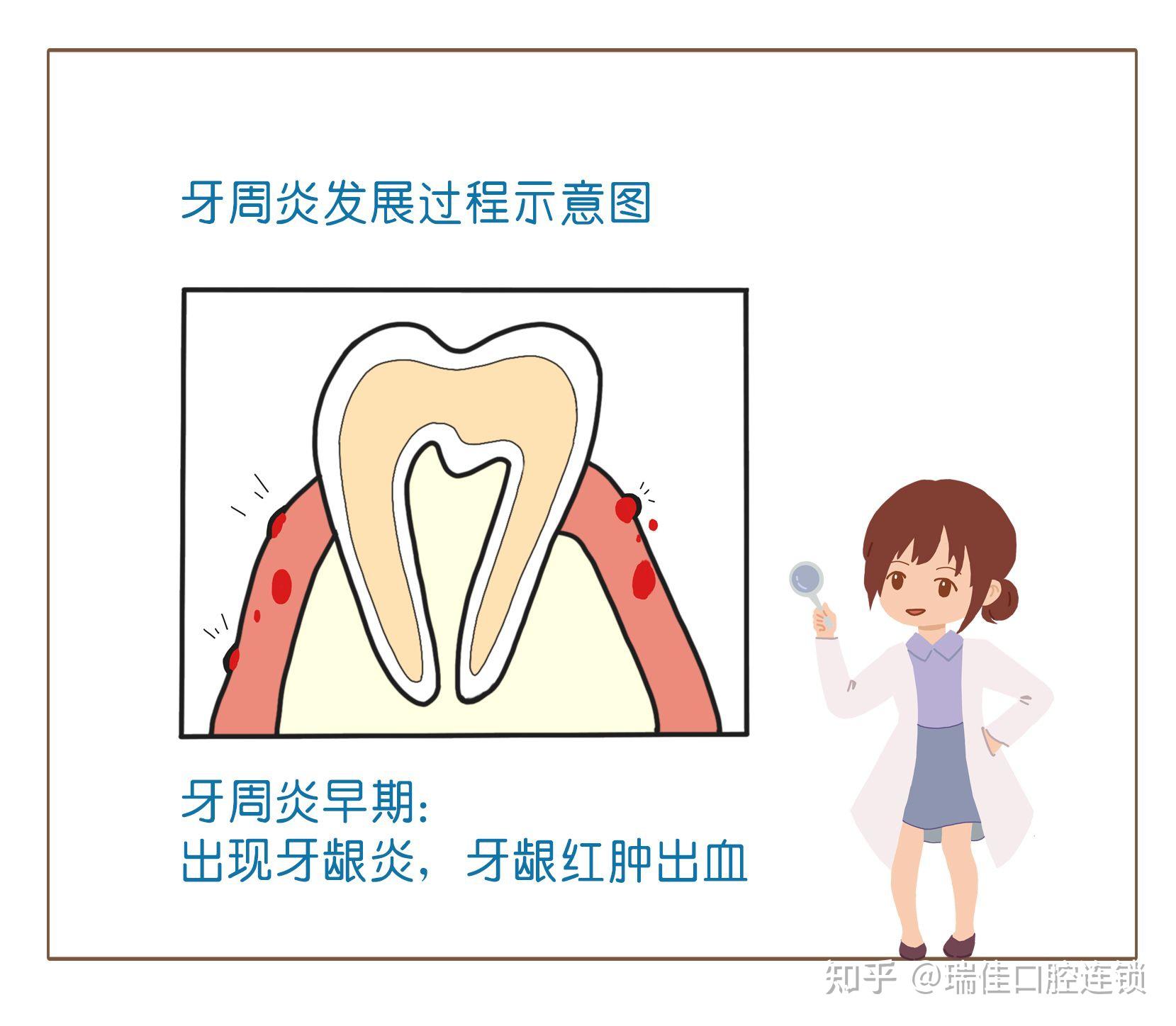 瑞佳医学小课堂之牙周炎