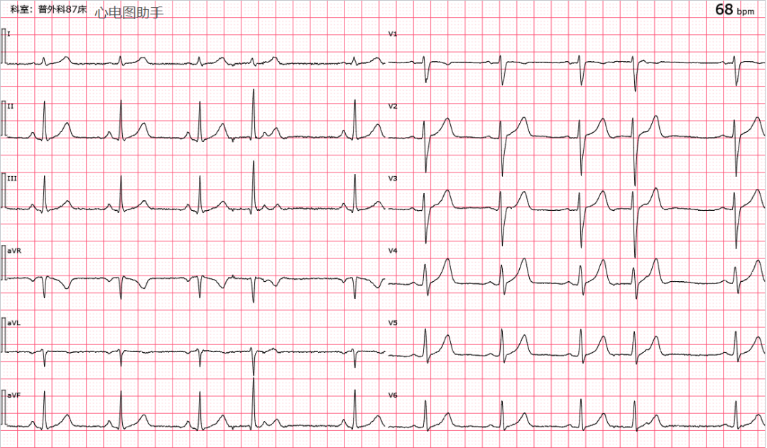 心電圖圖庫丨交界性早搏系列