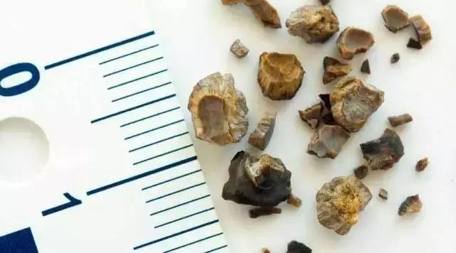 肾结石一般多久犯一次 v2-09abc5f26f9b1f5f3e6cb3ce21618163_1440w.jpg?source=172ae18b