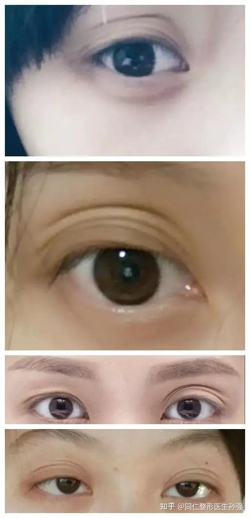 北京双眼皮科普怎么让多层眼皮变成双眼皮