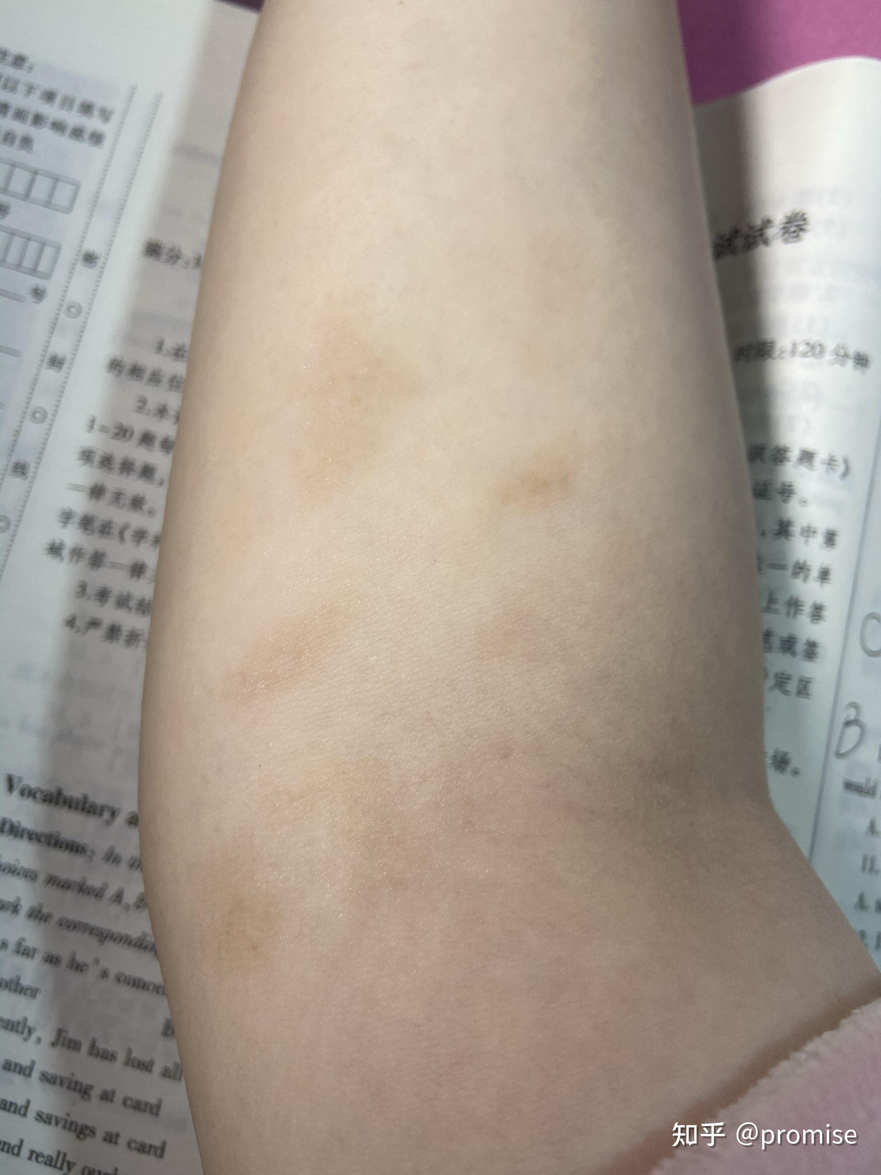浅二度烫伤处理以及后期恢复贴