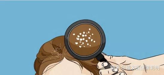 头屑问题怎么解决