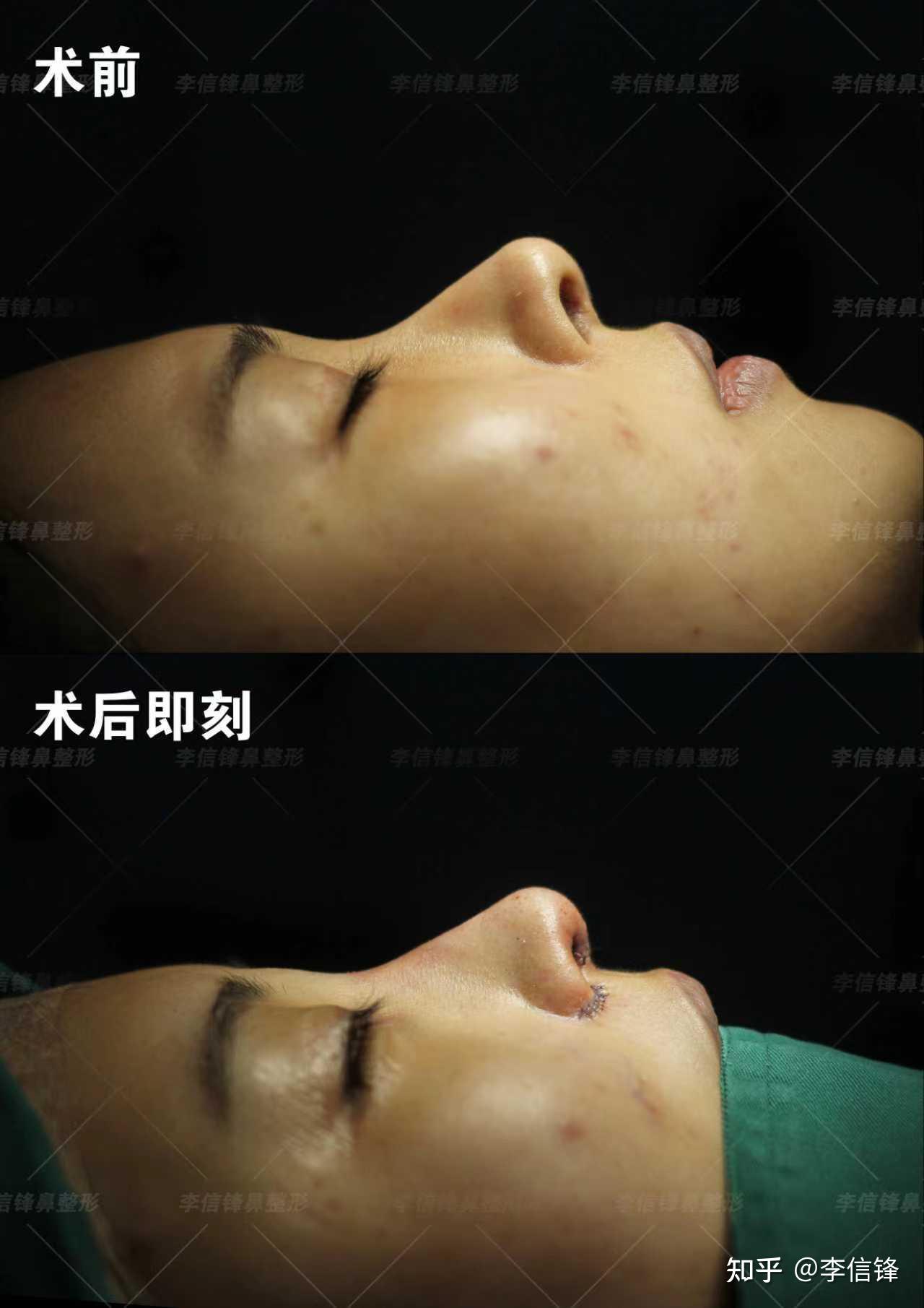 高难度鼻修复-鼻朝天漏鼻孔+疤痕+鼻中隔偏曲改善,术后即刻对比~ - 知乎