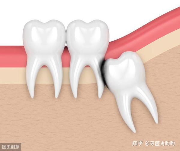 预防“智齿冠周炎”的4个小妙招！不再担心被智齿折磨了 - 知乎