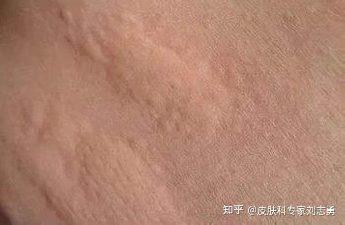 「荨麻疹」30%的人都会得的皮肤病,是什么原因?又该如何治疗? - 知乎