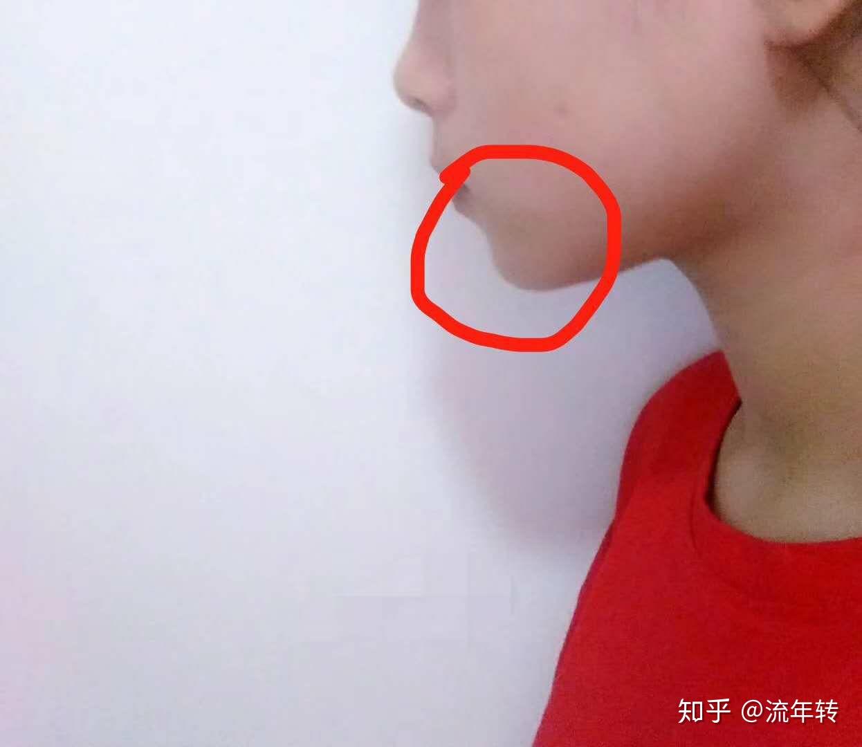 嘴凸笑露牙龈下巴后缩,除了手术还有救吗?