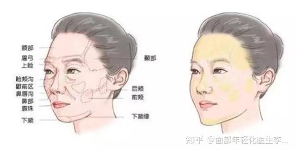 常见的面部凹陷类型有哪些及改善方式 - 知乎