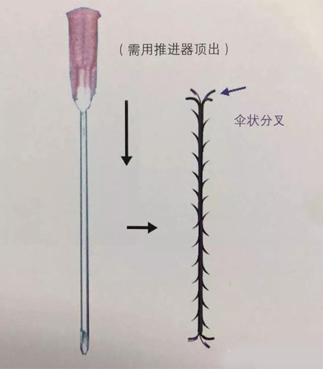 隆鼻后遗症有哪些 什么人容易中招 知乎