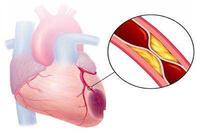 心肌梗死病人的护理