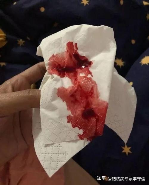 等,同时在治疗满2个月,5个月,6个月 (复治病人8个月)时要按期送痰复查