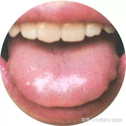 史上最全高清舌诊图谱,堪比教科书(收藏篇) - 知乎