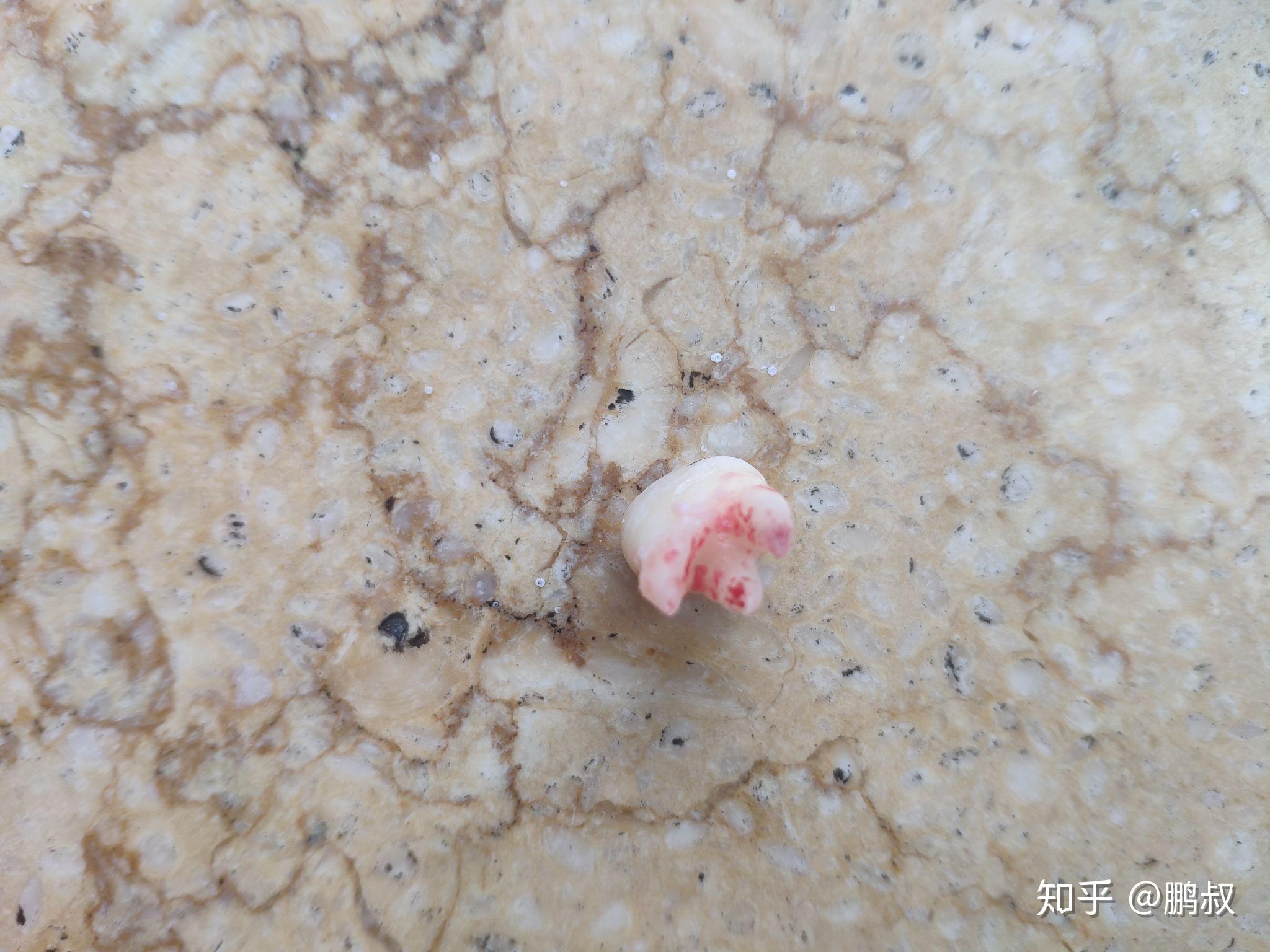 智齿冠周炎从发炎到拔掉到术后