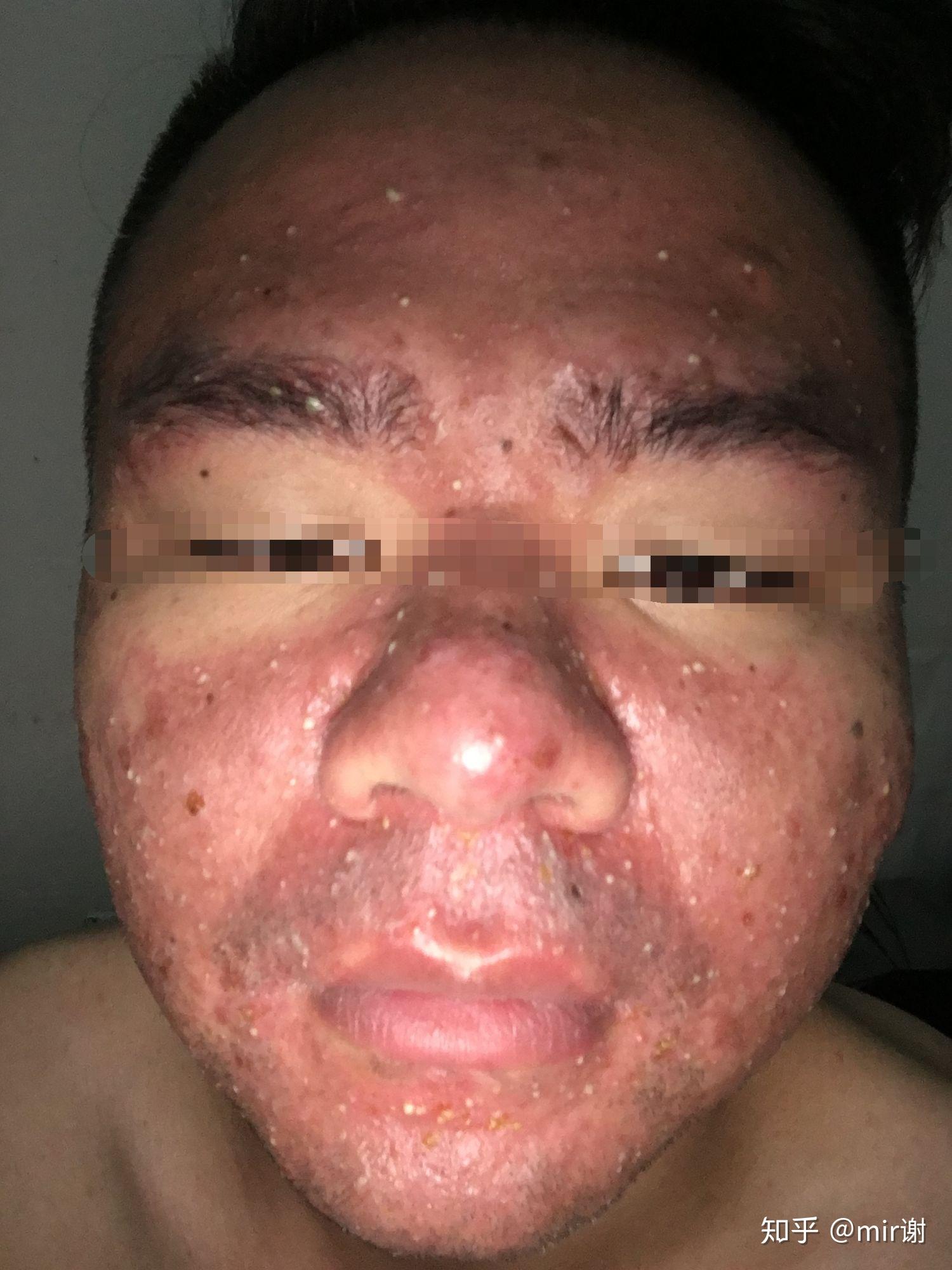 光动力治疗痤疮全记录