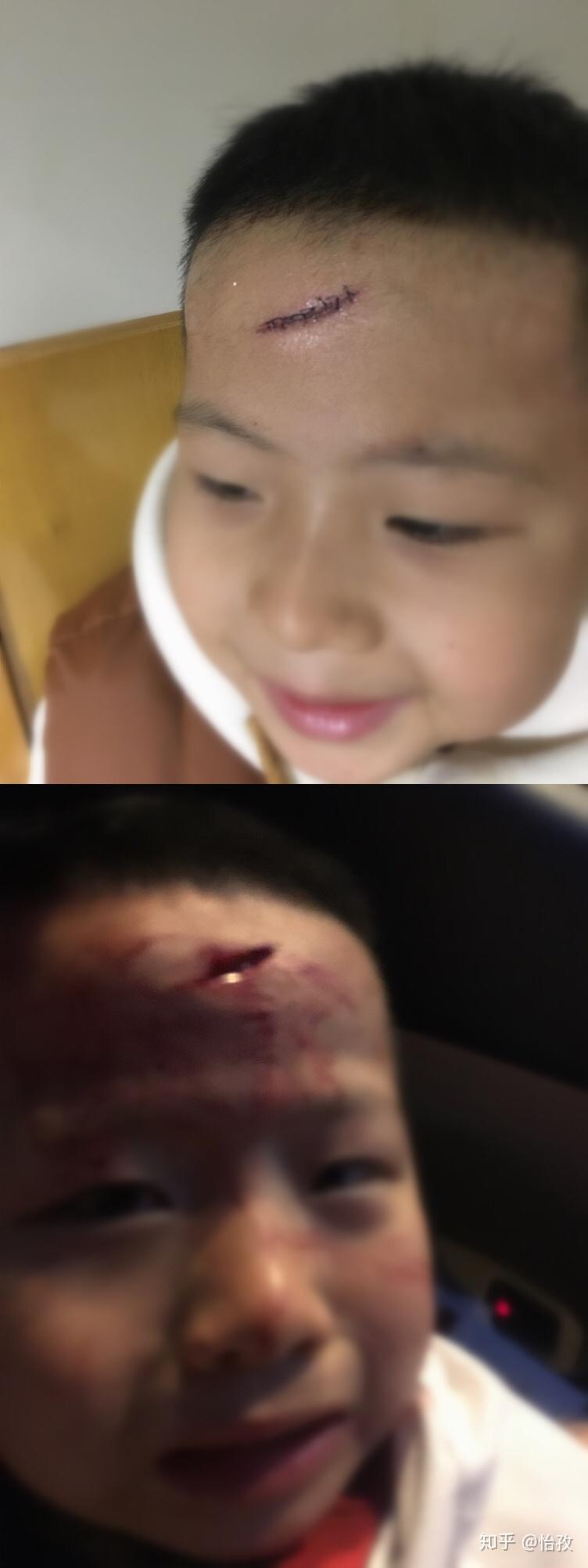 小孩打架受伤图片