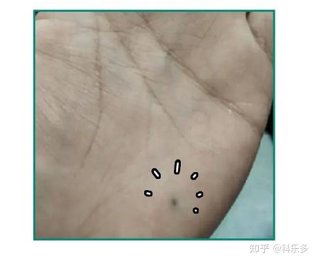 那些不小心进入身体的异物,最后咋样了? - 知乎