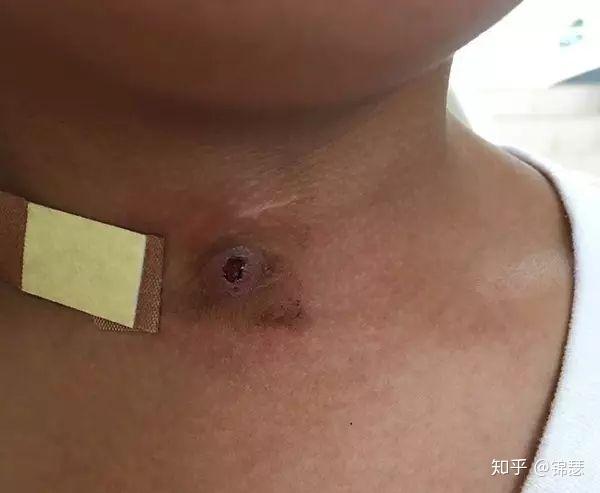 是个农村老太,脸色晦暗发黄,她的右肋下有一个深深的也是暗紫色的瘘管