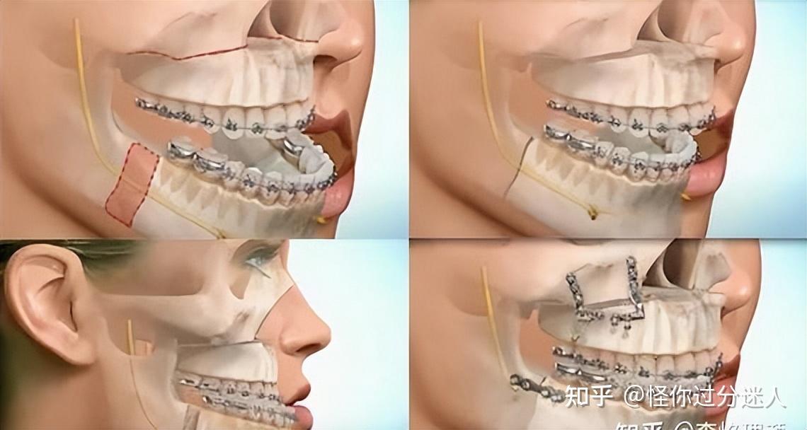 方脸磨骨有什么后遗症削骨一年后的忠告拿走不谢