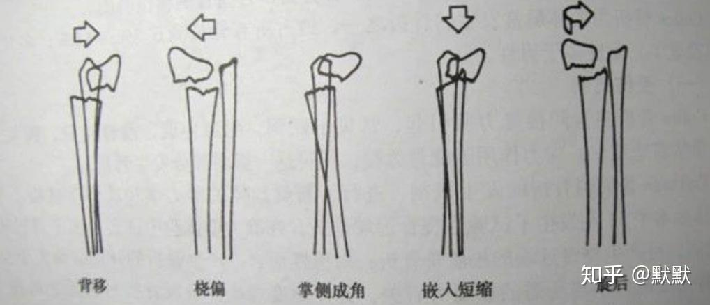 枪刺样和银叉样畸形图片