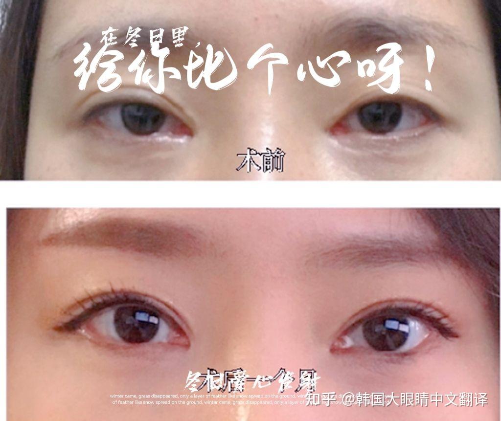 上海双眼皮、眼综合、双眼皮修复口碑医生整理 - 知乎