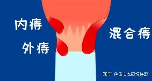 痔疮怎么区分一期二期三期四期?早点了解,别等到手术了才后悔 - 知乎