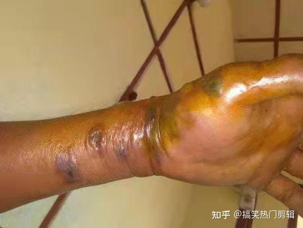 警惕山东14岁学生感染炭疽死亡