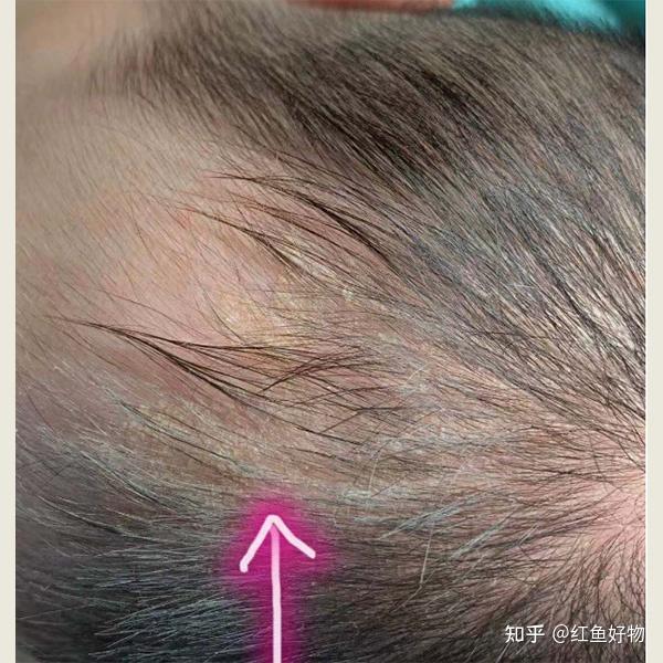 头屑头痒用哪种洗发水?止痒祛屑洗发水推荐 - 知乎